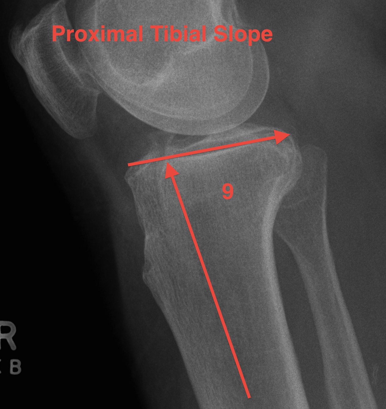 Proximal Tibial Slope